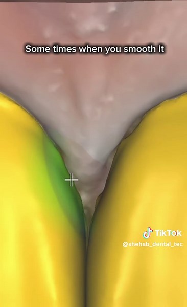 Essential Exocad Tips for Dental Students and Technicians