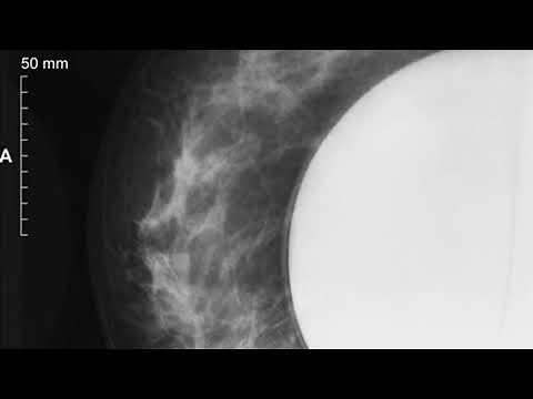 MAMOGRAFIA CON IMPLANTES