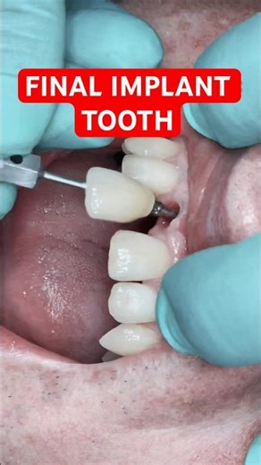 Final Step of a Dental Implant 🦷