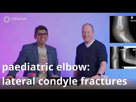 orthohub ODM: paediatric elbows - how to manage lateral condyle fractures – orthopaedic surgeons