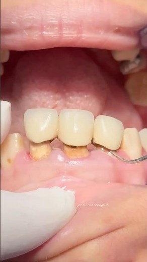 Replace old porcelain bridge with new zircon after fiber post placement #dentist