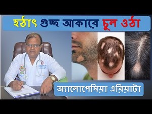Sudden hair growth in clumps | Alopecia Areata | Alopecia Areata | Dr Abdul Mannan