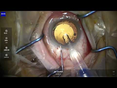Secondary sulcus intraocular lens surgery explained for patients