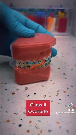 Different Ways To Wear Your Rubber Bands | Braces and Invisalign Orthodontics | St Charles, MO