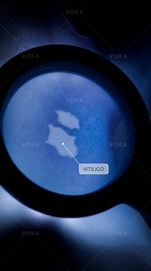 A Wood’s lamp is a specialized diagnostic tool that uses long-wave ultraviolet light to highlight subtle changes in the skin, scalp, and hair that are otherwise invisible to the naked eye. It is especially useful for: 🔹 Detecting fungal infections through characteristic fluorescence 🔹 Assessing the true extent of pigmentary disorders 🔹 Differentiating between similar-appearing dermatological conditions The procedure is quick, painless, and takes only a few minutes - helping healthcare provide