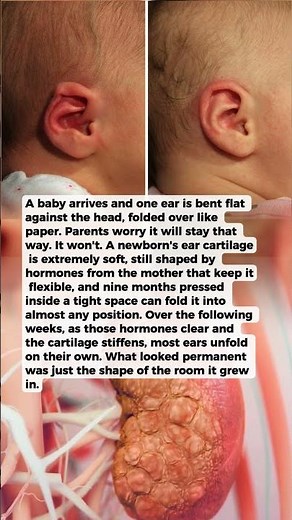 Why a Newborn's Ears Can Be Folded and Crumpled at
