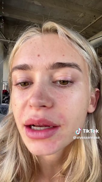 nov 2022 —> now | lip filler