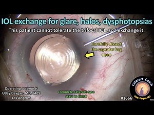 CataractCoach™ 1666: IOL exchange for glare, halos, dysphotopsias