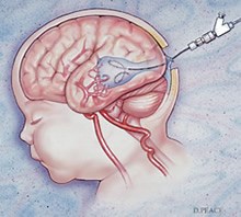 Vein of Galen Malformation »  Lillian S. Wells Department of Neurosurgery at the University of Florida » College of Medicine » University of Florida