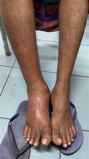 Patient with Right lower limb cellulitis