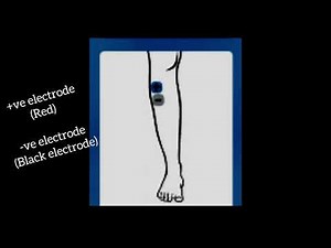 Electrode placement for Tibialis Anterior Muscle