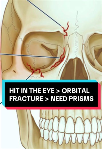 Binocular Vision Dysfunction (BVD) - Understanding Prism Glasses After Orbital Fracture