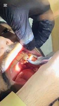 Extraction of left 1st molar 🦷 #dentist