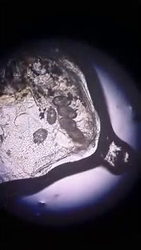 Scabies - moving around on mineral oil skin scraping preparation