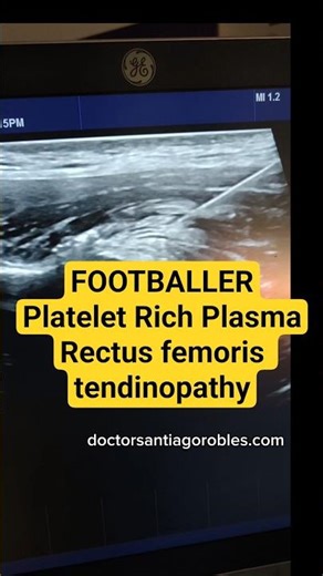 PRP injection for direct head rectus femoris tendinopathy