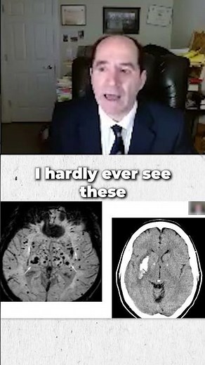 What is amyloid angiopathy of the brain?