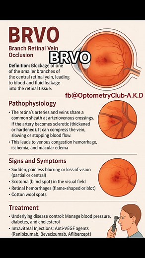 30K views · 408 reactions | What is BRVO (Branch Retinal Vein...