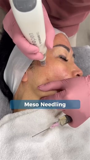 𝗟𝗮𝘀𝗲𝗿𝗔𝗹𝗹 | Dermal Skin Clinic: Picoway | Hydrafacial 📍Sydney on Instagram: "Have you had the neopen® custom Mesoneedling procedure yet? With this innovative treatment it is possible to treat a wide range of skin issues, including: ☑️hyperpigmentation ☑️dehydration ☑️stretch marks ☑️scars ☑️rosacea ☑️hair loss When using the Toskani Mesotherapy line in combination with neopen® by Toskanimed. Schedule a treatment at @laseralldermal today that is specifically tailored to your needs! We rec