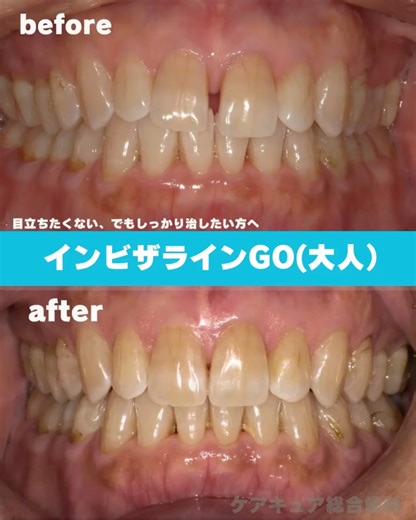 マウスピース矯正ならケアキュア総合歯科松戸/口腔外科/小児歯科/矯正歯科 on Instagram: "本日はインビザラインGOによる歯列矯正の症例をご紹介いたします。【プチ矯正】 担当施術歯科医師はDr.加藤です。 こちらの患者様は前歯の隙間と、下顎の乱れを改善されたいとのことで矯正をご希望されました。 部分矯正のGO適応症例でしたので、期間は4ヶ月ほどでした。 30代 女性 合計費用：45万円ほど（検査費用・保定装置） 矯正期間：4か月(保定を除く) 当院ではこちらの症例のように軽度の歯列矯正から、重度の歯列矯正まで患者様のご要望に合わせて小児から成人まで幅広いインビザライン治療を取り扱っております。 総合歯科ですので、矯正治療前後の補綴治療との組み合わせも可能ございます。 無料の矯正相談を行っておりますので、リンクよりお気軽にお問い合わせください。 お電話 047-361-8211 メール infoccdmatsudo@gmail.com #矯正 #インビザライン #松戸#矯正歯科#マウスピース矯正プチ矯正部分矯正"