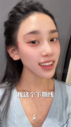 Xiao Zhong Ye on Instagram: "A Second Chance at a Real Lift She’d tried facial liposuction before — but instead of lifting, her face felt looser, heavier, and more tired. This time was different. With a 9D lipo-lift, excess fat was removed and structural lifting was restored. Day by day, swelling went down. Tightness came back. And when the tape came off — the jawline finally showed up. Sometimes it’s not about doing more. It’s about doing it right. #9DLift #drxiao9d #JawlineReveal #FacialLipoLi