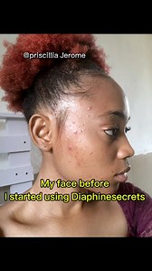 33K views · 223 reactions | At first I stopped the bleaching products that’s almost ruined my skin, I battled with acne’s, stretch marks, pigmentations, and rough skin, I focused on regaining my original colour back then I started using Diaphinesecrets to now maintain my color while giving me the glowing and smooth looking skin  and now I regained back my self confidence 殺 contact them to get yours today #foryou | Priscillia Jerome | Facebook
