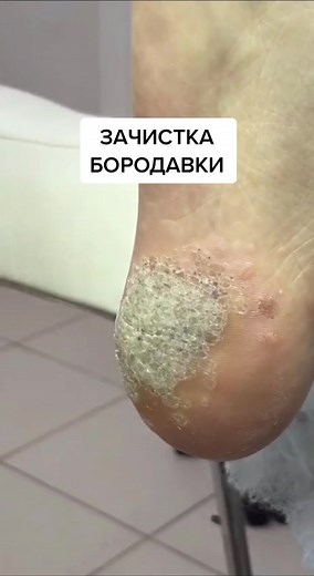 Foot Fungal Infection Treatment: Effective Medical Procedures