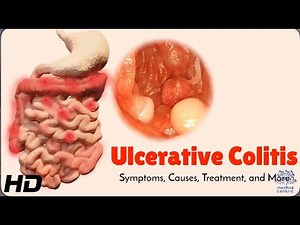 Ulcerative Colitis Explained: Symptoms, Causes, and Treatment Options
