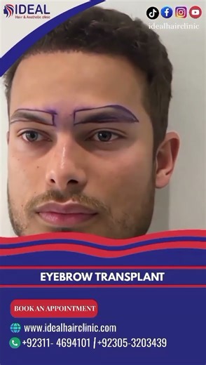 🔥 Shape Your Confidence | Permanent Eyebrow Transplant Result