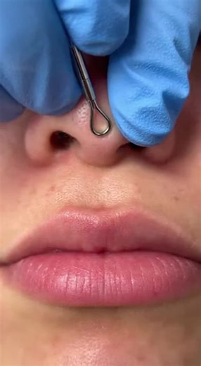 Effective Blackhead Removal for Lips