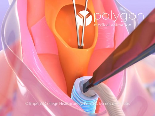 喉癌喉咙切除外科重建术动画片