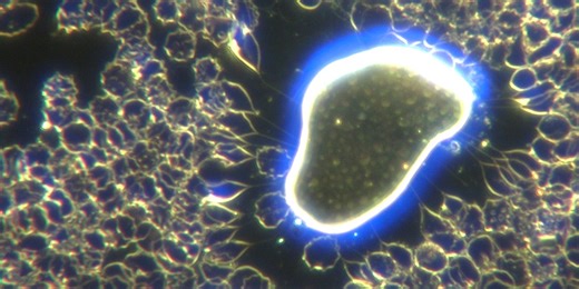 Darkfield Live Blood Analysis of COVID19 Unvaccinated With Interesting Self Assembly Nanotechnology Findings Showing Severe Injury To Blood