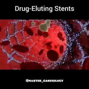 🔷️🔷️Drug-eluting stents (DES) reduce the rate of restenosis and, accordingly, target lesion revascularization compared to bare metal stents (BMS). DES consist of a standard metallic stent, a polymer coating, and an anti-restenotic drug (eg, sirolimus or a derivative of sirolimus or paclitaxel) that is mixed within the polymer and is released over a period of weeks to months after implantation to reduce the local proliferative healing response. . . Great post from @master_cardiology . . #cardia