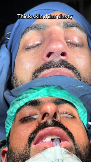 #dribrarent #rhinoplastypakistan #dribrarrhinoplasty #rhinoplastyturkey #ultrasonicrhinoplasty