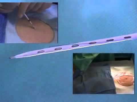 ReSolve® and ReSolve+™ Locking Drainage Catheter Video