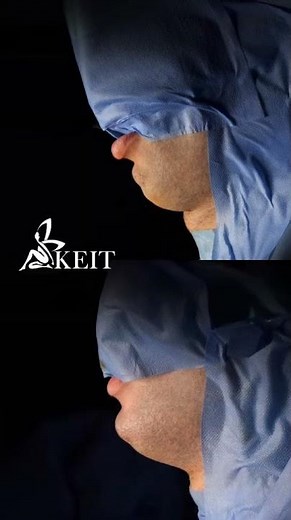 Mentoplasty Transformation: Before & After Chin Surgery at KEIT Clinic