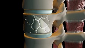 Injection Of Bone Cement For Fractured Vertebrae