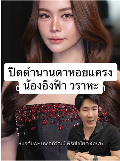 ปิดตำนาน ชั้นตาหอยแครง น้องอิงฟ้า ตาหวานมากกกก นี่แหละๆ! #หมอต้นaf #หมอต้น #หมอมีทุกคําตอบแค่คุณบอกคําถามคือ #หมอต้นapiclinic #tiktokความงาม #apiclinic #วิเคราะห์ใบหน้า #fyp #หมอให้ความรู้ #อิงฟ้า #อิงฟ้าวราหะ #อิงฟ้ามหาชน #แก้ตา #EngfaWaraha