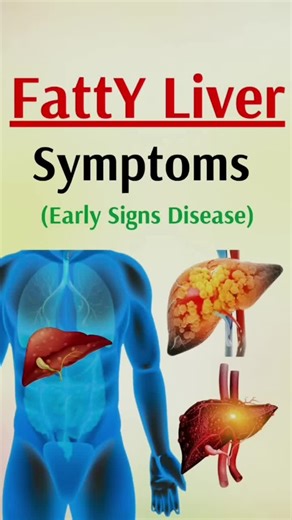Understanding Early Signs of Fatty Liver Disease