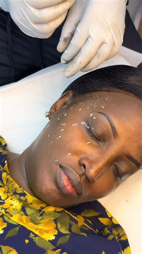 Skin Tag Removal Process Explained