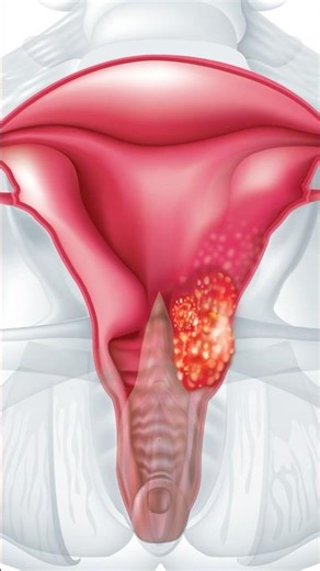 The #1 cause of cervical cancer explained