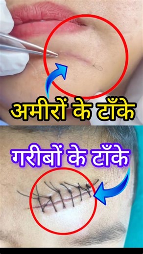 Satish Patel | Surgical stitches Types of suture Surgical knowledge OT knowledge #trendingreels #doctor #health #hospital #healthtips #nursing... | Instagram