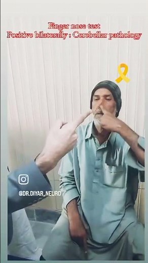 Finger Nose test | Cerebellar disease | Neurology | Examination | stroke | Mrcp | PLAB | USMLE