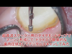 超音波スケーラー用のダイヤモンドチップでマージン形成して、ドライズで簡易的な歯肉圧排をしてデジタルスキャンしてみた