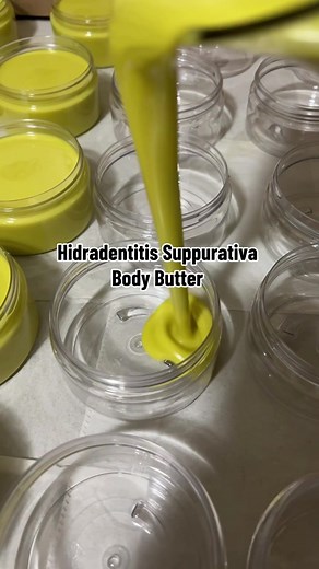 Understanding Hidradenitis Suppurativa: Causes, Symptoms, and Treatment