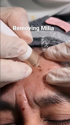 Removing milia - cysts under surface of skin
