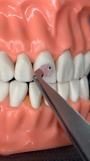 🔥Paso a Paso , Instalación de Brackets 😬 Estéticos de ORTODONCIA🔥 | Centro Especializado Diler Cruz