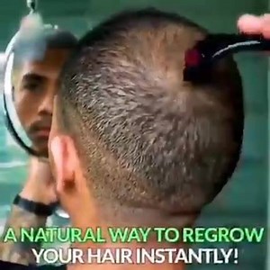 6.1K views · 69 reactions | Derma Roller Microneedling Kit for Face, Beard, and Hair Growth Buy via Amazon : https://amzn.to/39NEJ6f | Dubaï | Facebook