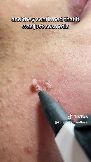 Effective Filiform Wart Removal with Advanced Electrolysis