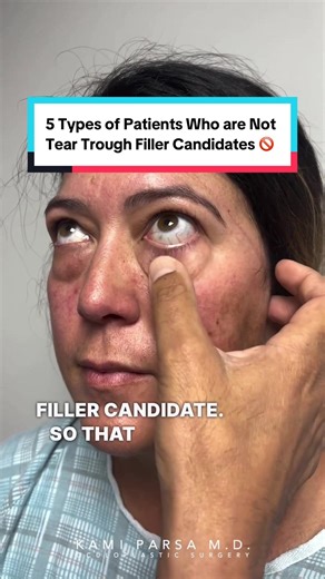 5 Patients Who Should Avoid Tear Trough Fillers