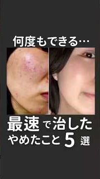 5 things I stopped doing to get rid of recurring acne as quickly as possible #acne #acnetreatment...
